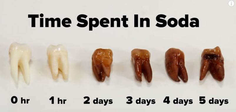 Soda Sugar Bugs Tooth Decay What You Need To Know Hough Orthodontics
